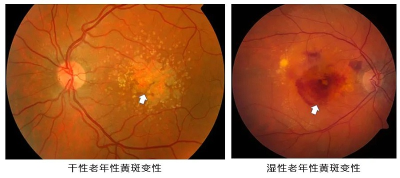 水蛭素、黃斑變性