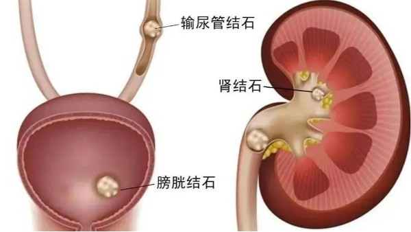 重用、活用水蛭治療尿路結(jié)石，療效較好