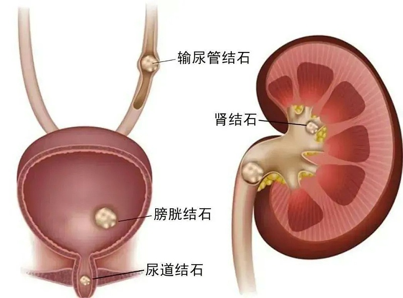 水蛭素、尿路結(jié)石、腎功能