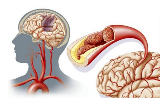 水蛭素、急性腦梗死、中風