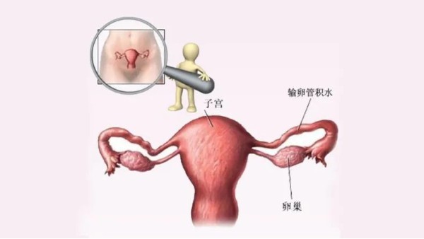 水蛭有利水道、破積聚之功，可用于治療輸卵管積水