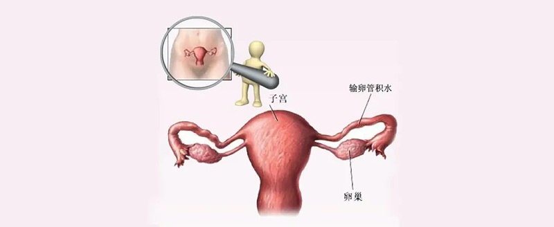 水蛭素、輸卵管積水、不孕不育