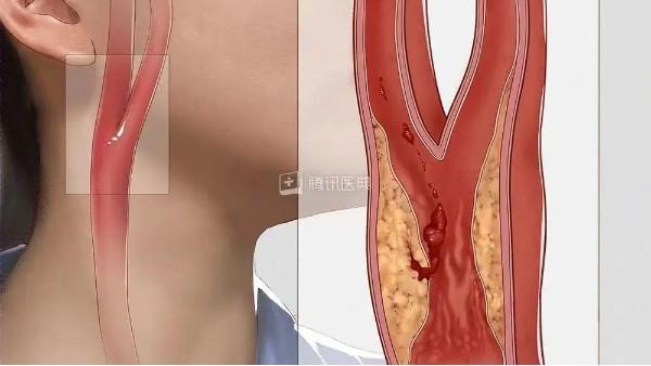 真實(shí)案例丨3個(gè)月左頸動(dòng)脈狹窄降低約27%，是怎么實(shí)現(xiàn)的？