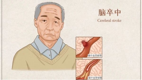 “中風”是吃出來的？研究發(fā)現(xiàn)：這類食物促進炎癥，中風風險增加87%！