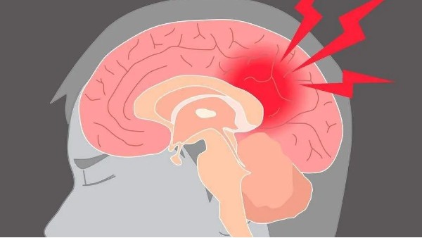 水蛭治療缺血性腦血管病療效肯定、安全簡便，已被各家公認(rèn)