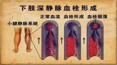 水蛭素、水蛭素膠囊、壯醫(yī)水蛭療法