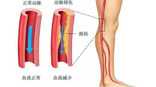 水蛭在改善下肢動脈硬化性閉塞癥中發(fā)揮重要療效，安全性及可行性較高