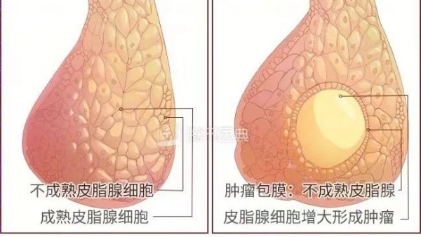 真實(shí)案例 | 腫瘤克星，百姓福音——現(xiàn)代壯醫(yī)水蛭療法