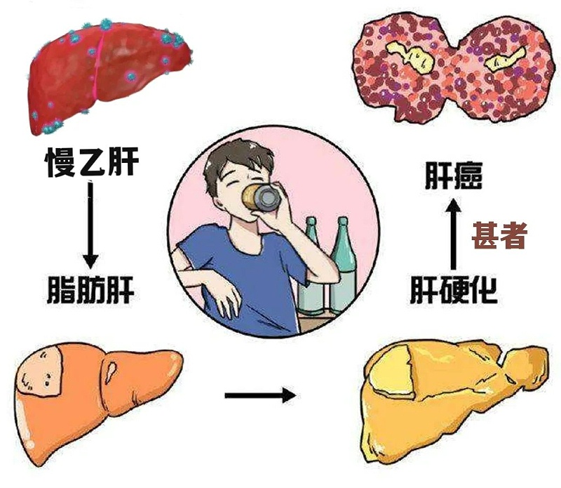 水蛭素、肝硬化、脂肪肝