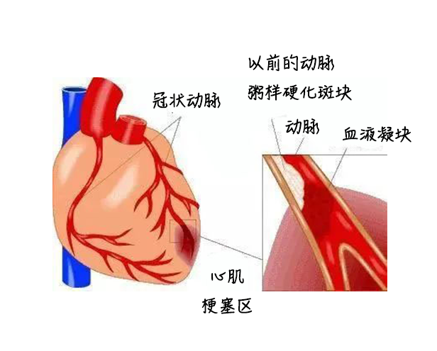 中醫(yī)藥健康旅游、心梗、面癱