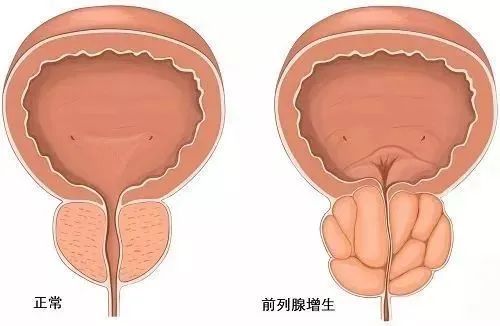 水蛭素、前列腺增生、前列腺肥大