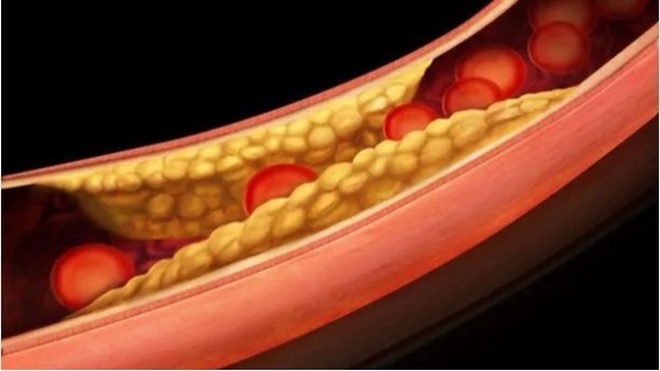 三高如何引起動脈粥樣硬化斑塊？——高血壓篇