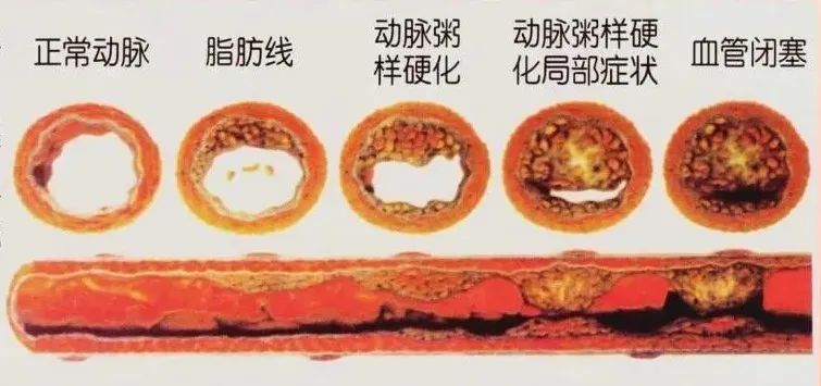 水蛭素、動脈粥樣硬化、高血壓