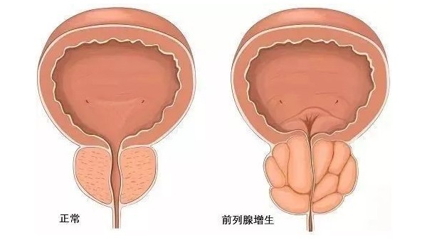 水蛭在改善前列腺增生臨床癥狀、提高生活質(zhì)量方面發(fā)揮重要作用